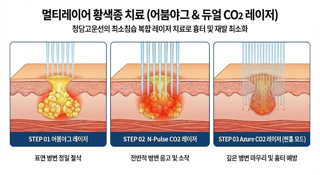 황색종 3단계 레이저 원리